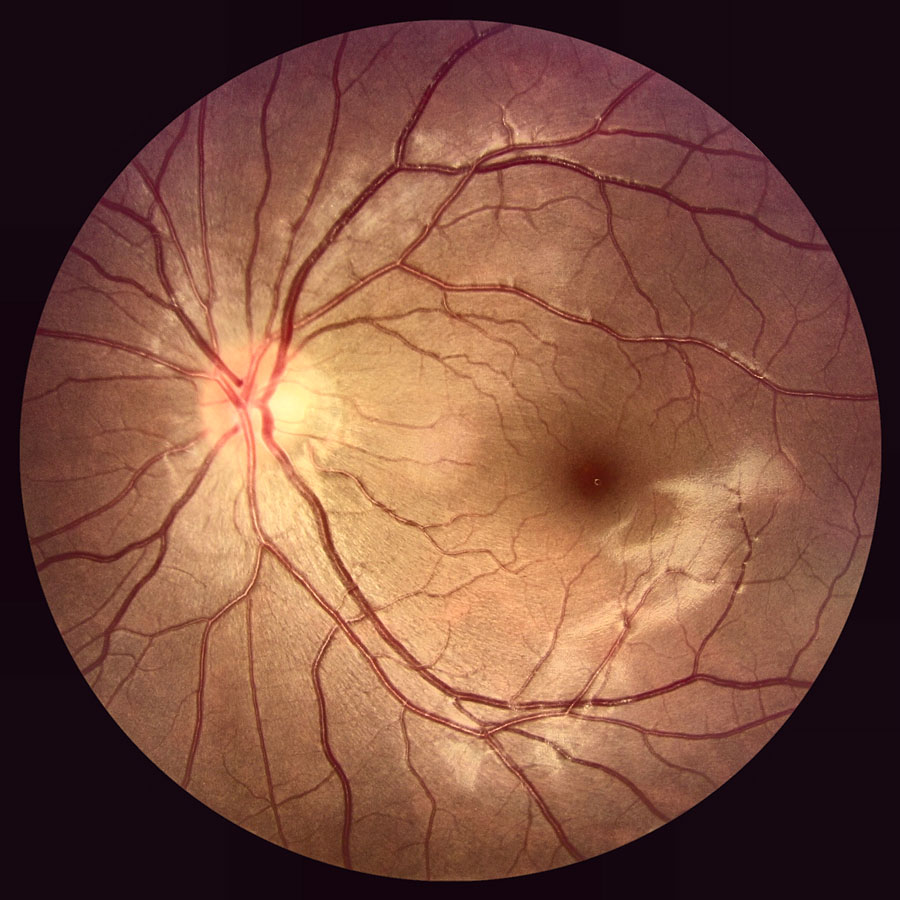 인간의 안저(eye fundus)를 촬영한 의료 스캔 이미지입니다.