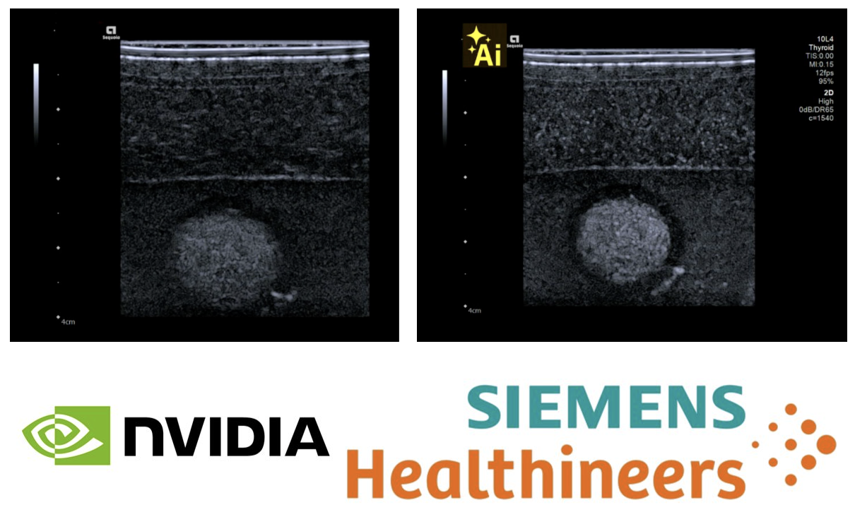 일반 초음파 영상과 AI 보정이 적용된 영상의 화질 비교